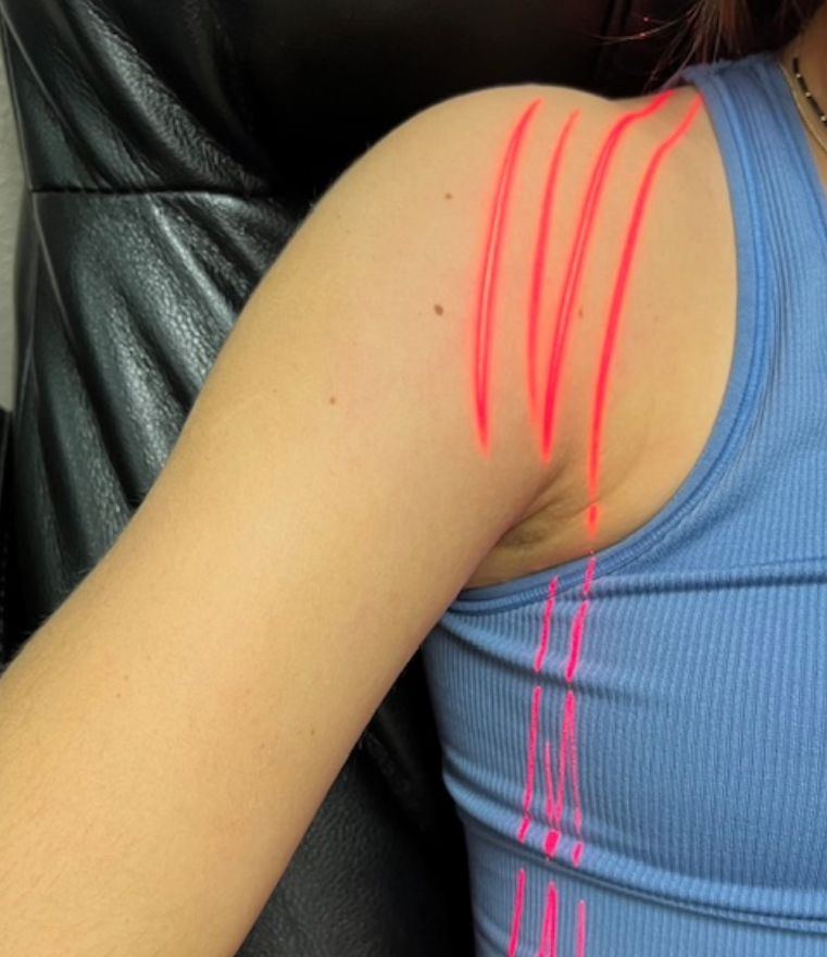 Cold laser therapy being applied for shoulder rotator cuff tendonitis at Spring Physical Therapy.
